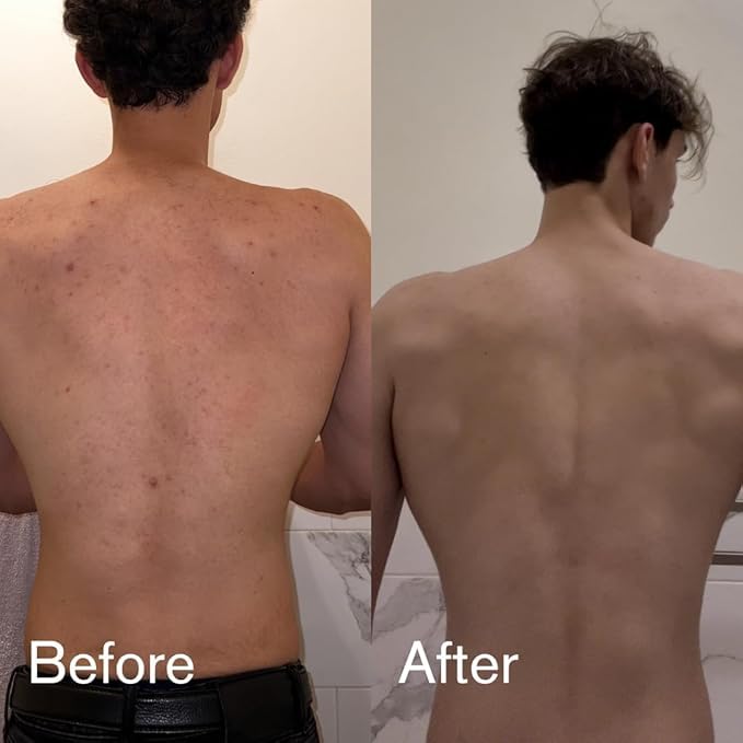 Shield Acne Wash Bundle for Men and Boys – Deep Clean Gel Formula Face Wash and Unscented Back & Chest Cleanser, Clears Acne & Breakouts, 13.6 oz