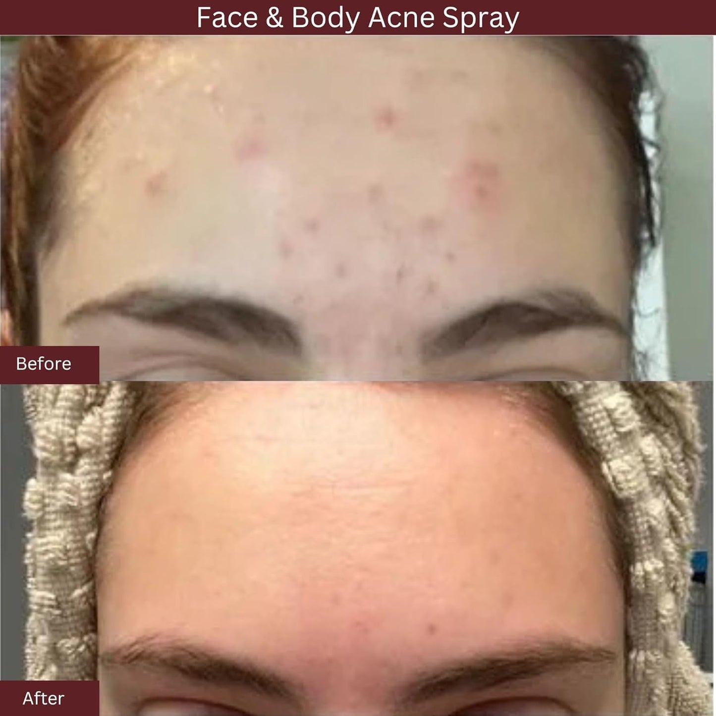 ITK Skincare 2% Salicylic Acid Spray for Face & Body Acne, Blackheads, Pimples & Blemishes – BHA Post-Workout Mist, 3.3oz