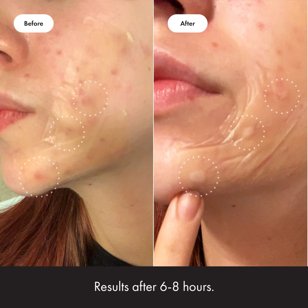 Hero Cosmetics Mighty Patch Surface Large Pimple Patches โ Acne Spot Stickers for Face & Body, Hydrocolloid, Vegan, 10 Count