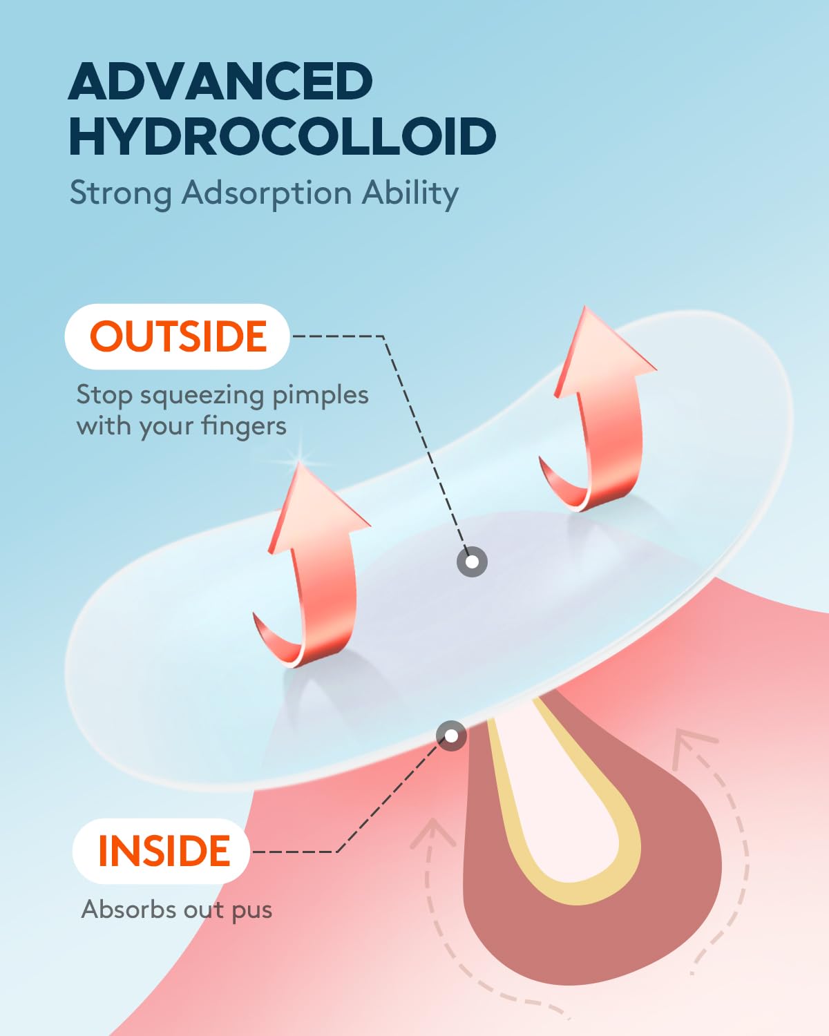 ZATKTK Acne Pimple Patch - 180 Hydrocolloid Spot Patches, 4 Sizes, Tea Tree & Calendula Oil, Invisible Acne Treatment for Face, FSA Eligible