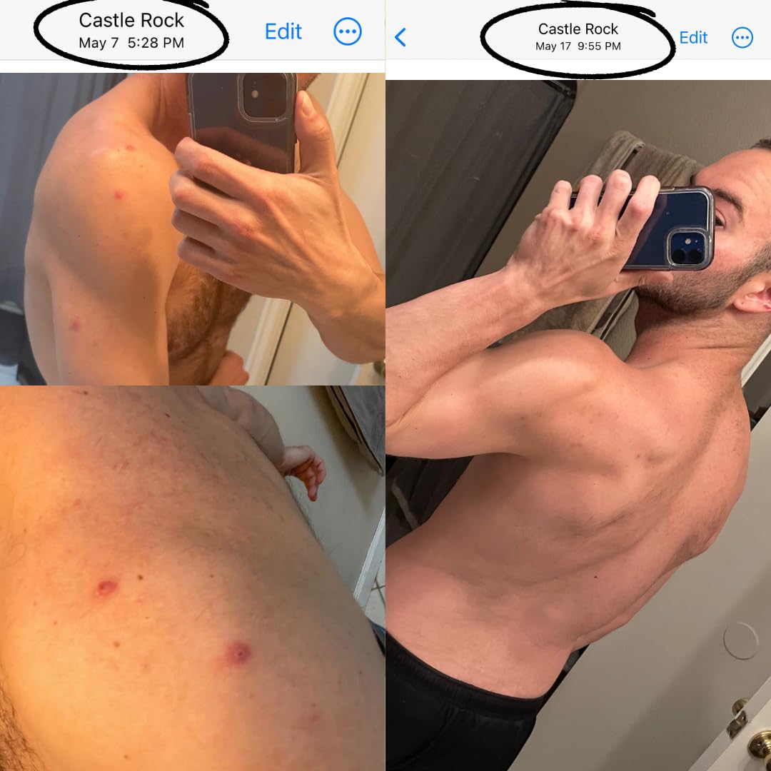 Bacne Bar – All-Natural Back Acne Soap with Charcoal, Pumice, Tea Tree & Vitamin E for Deep Exfoliation, Not for Sensitive Skin