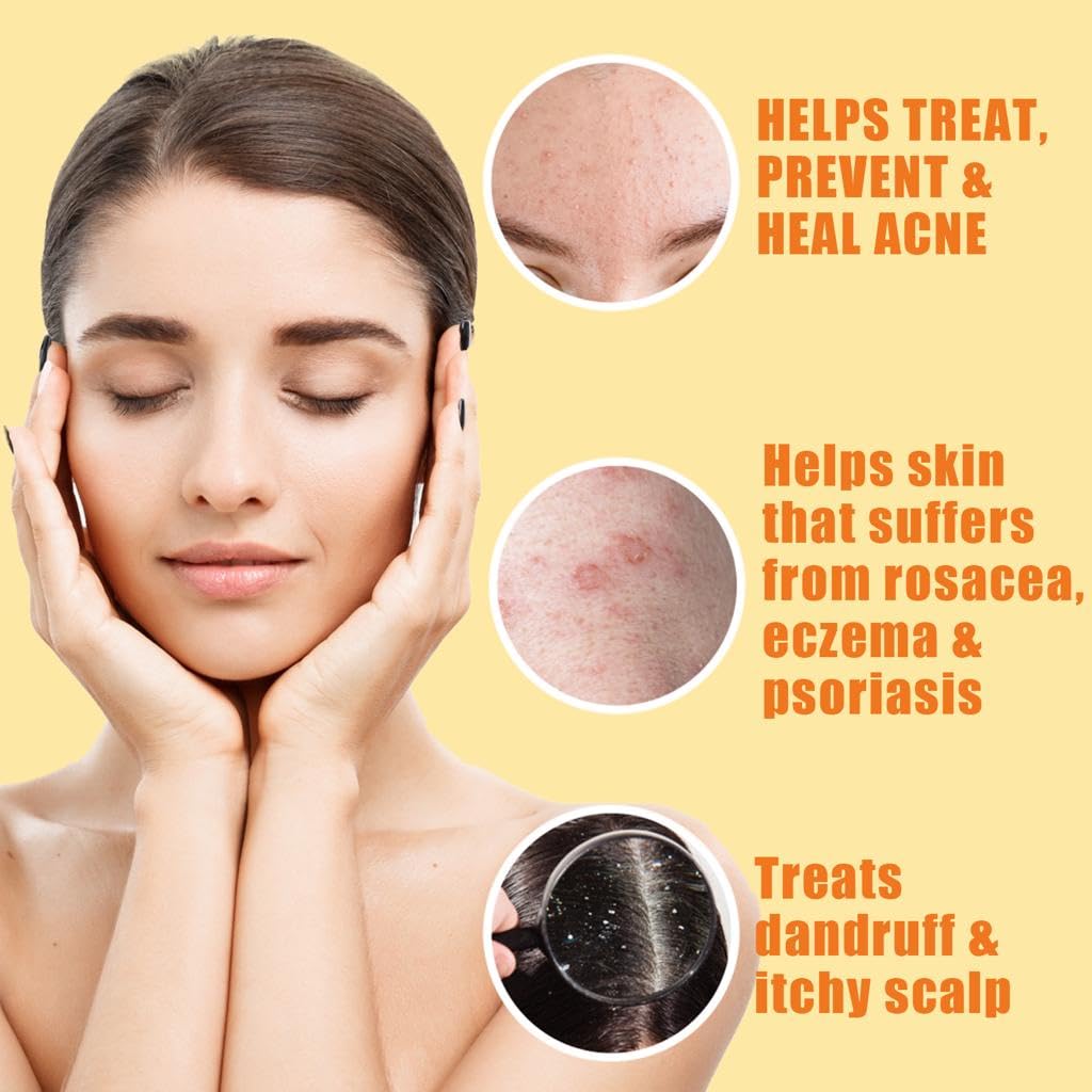 10% Sulfur Soap Bar for Face & Body – Natural Acne & Oily Skin Cleanser with Tea Tree, Lemongrass, Vitamin E & Coconut Milk – USA Made