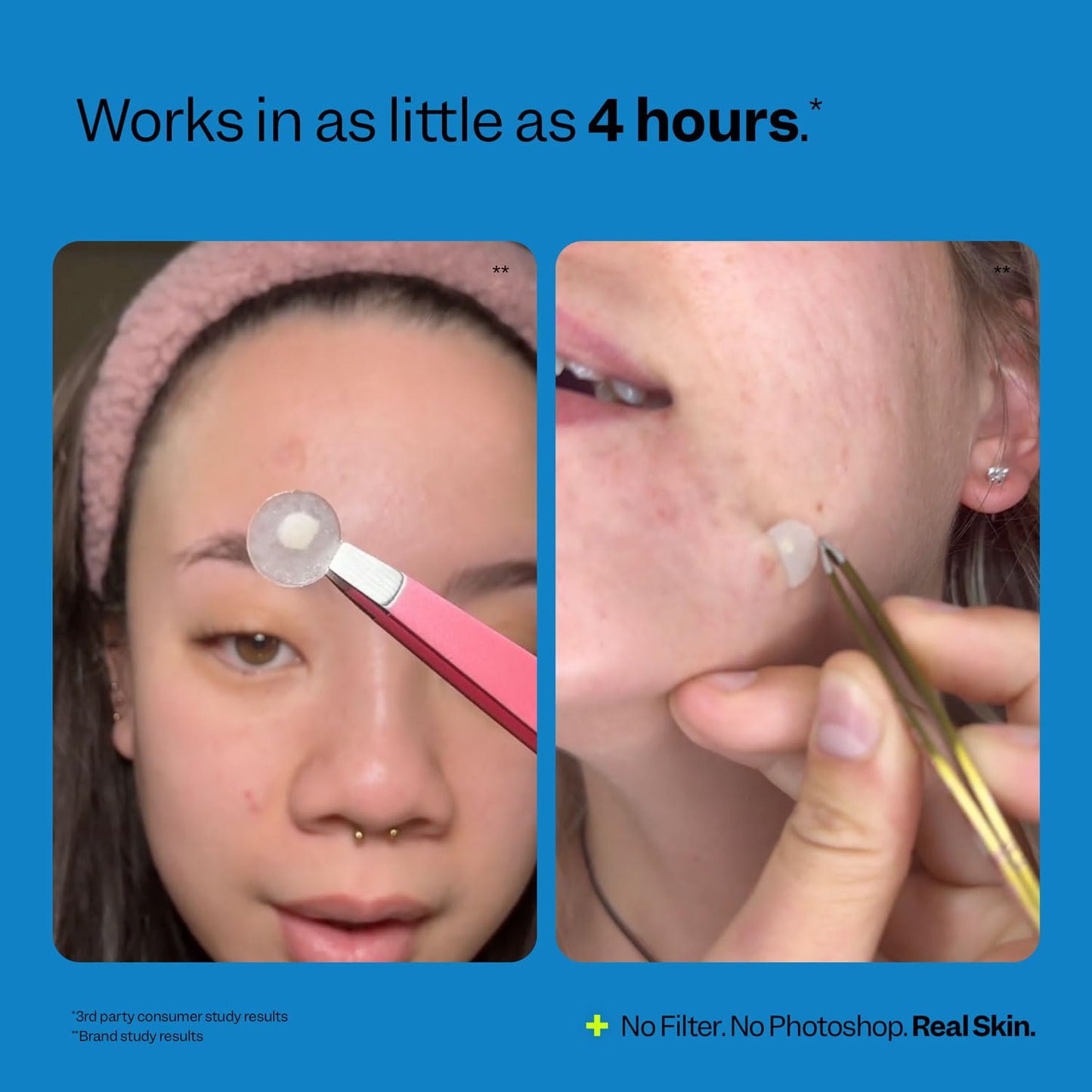 Peach Slices Acne Spot Dots – Hydrocolloid Pimple Patches for Zits & Blemishes, Vegan & Cruelty-Free, 3 Sizes, 30 Ct