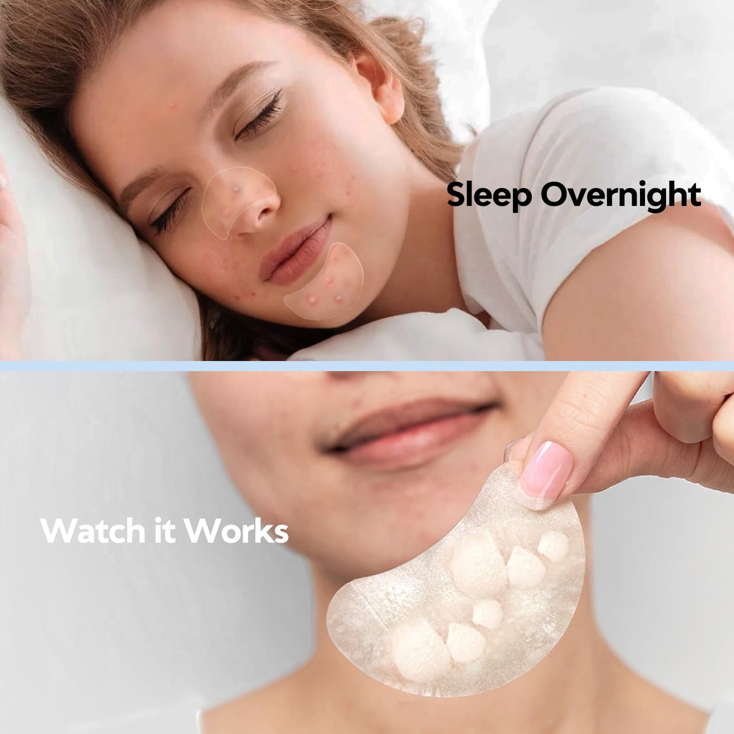 Large Acne Pimple Patches for Face – 331 Hydrocolloid Spots, 7 Sizes, Tea Tree, Salicylic Acid & Cica Oil, Big Spot Covers