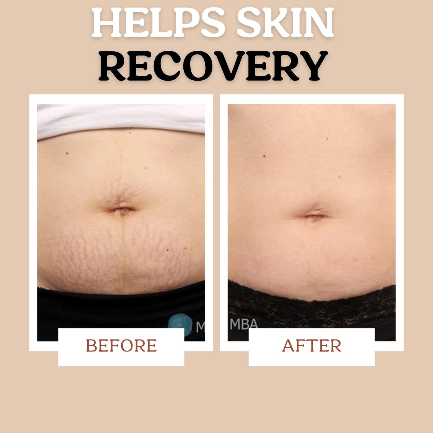 Roe Wellness Stretch Mark Cream for Sensitive Skin โ Plant-Based, Hydrating, Firms & Improves Elasticity, Long & Short-Term Care