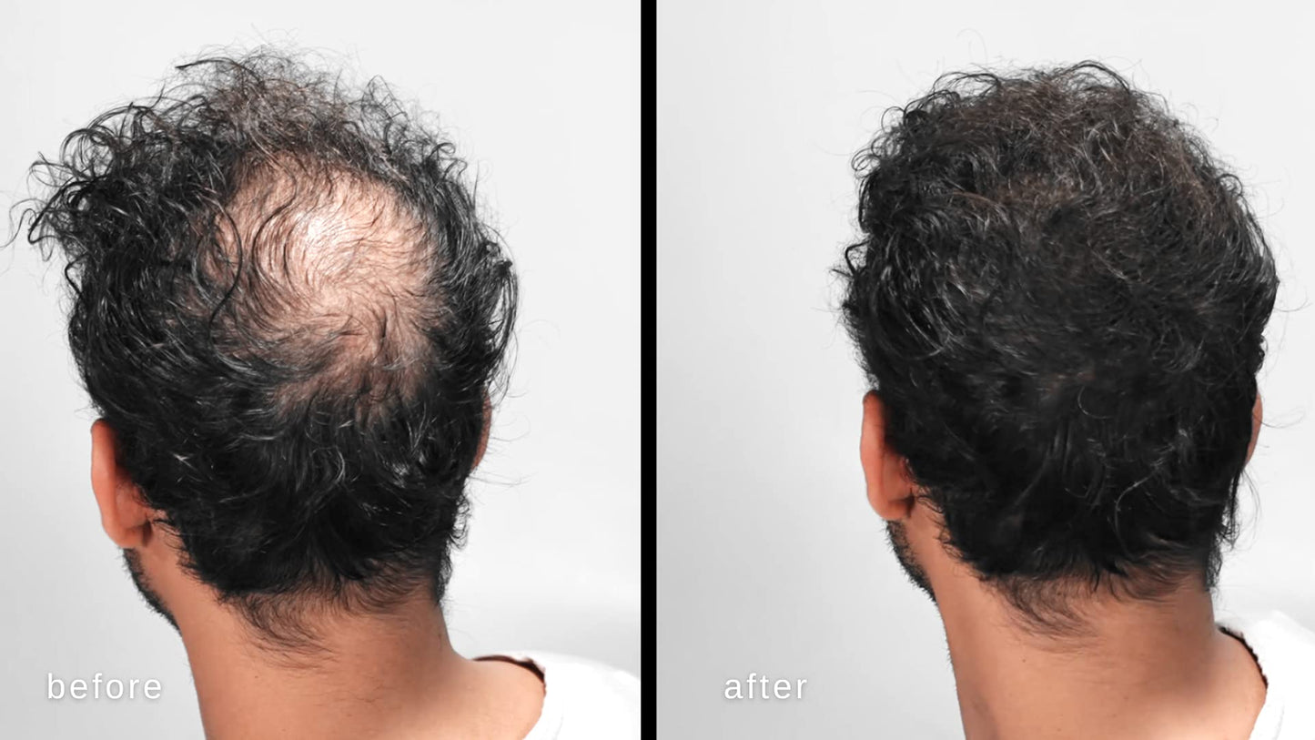 LUXE Hair Building Fibers for Thinning Hair – Dark Brown – Thickening Fibers, Hypoallergenic, Dermatologist Tested, 2+ Month Supply