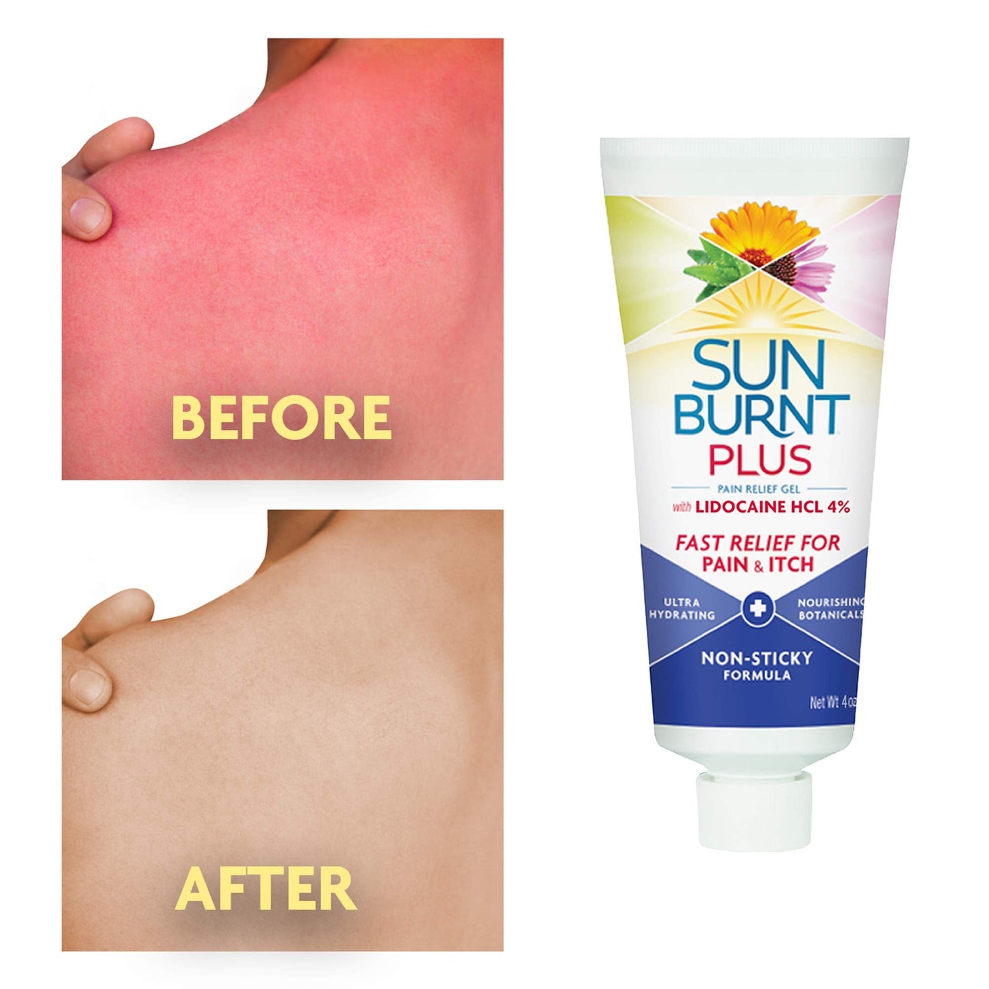 Sunburnt Plus After-Sun Gel with Lidocaine, 4 Ounce