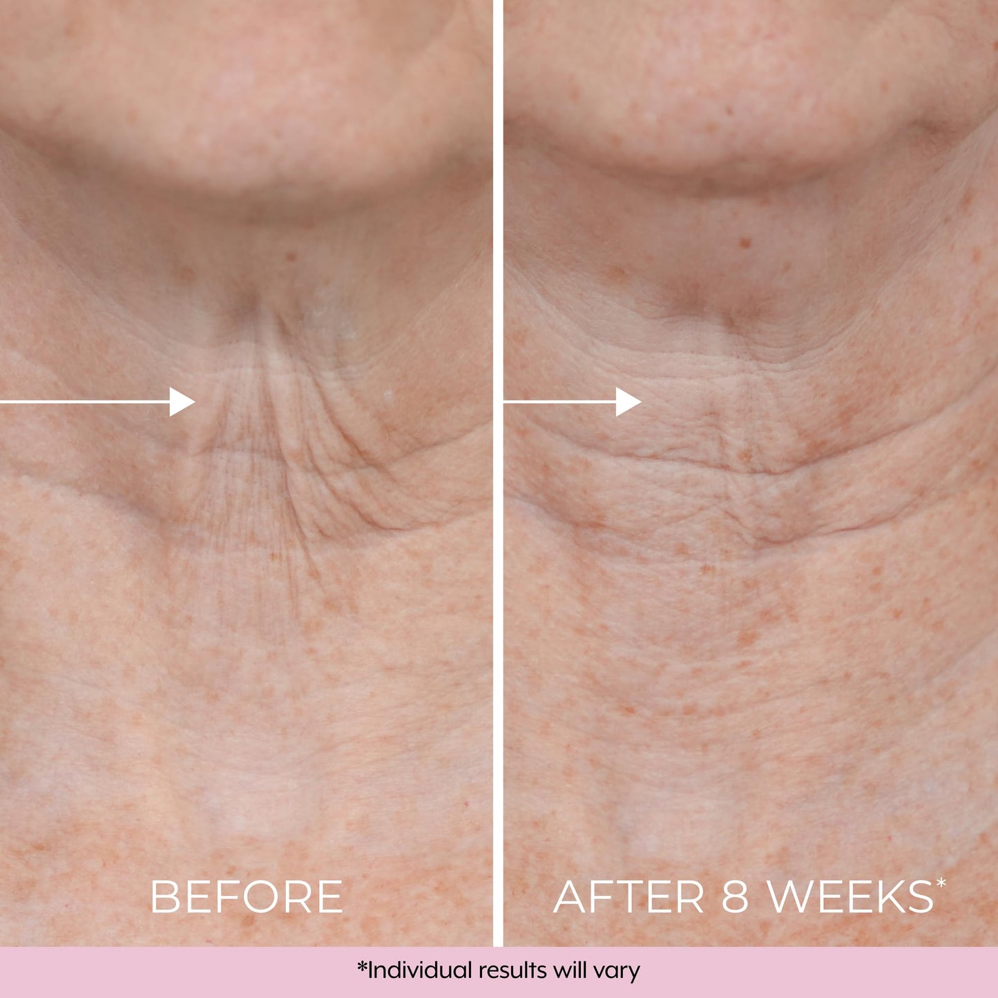 DEKLIDERM Neck Firming Cream – Anti Aging Retinol Cream Visibly Reduces Neck Wrinkles and Sagging – Neck Cream for loss of Firmness