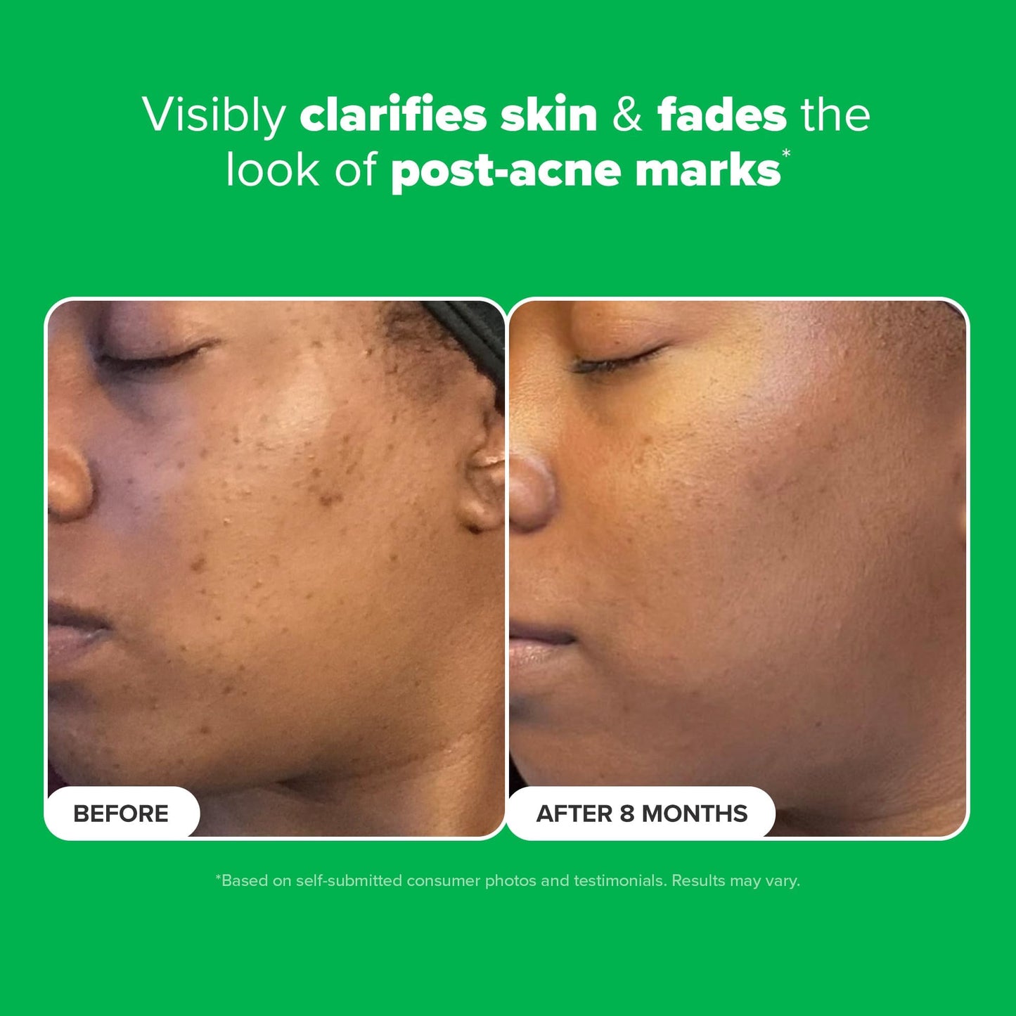 Paula's Choice BOOST 10% Azelaic Acid Booster Cream Gel Face Serum with Salicylic Acid, Oil-Free Skin Brightening Serum for Face, Fragrance-Free, 1oz