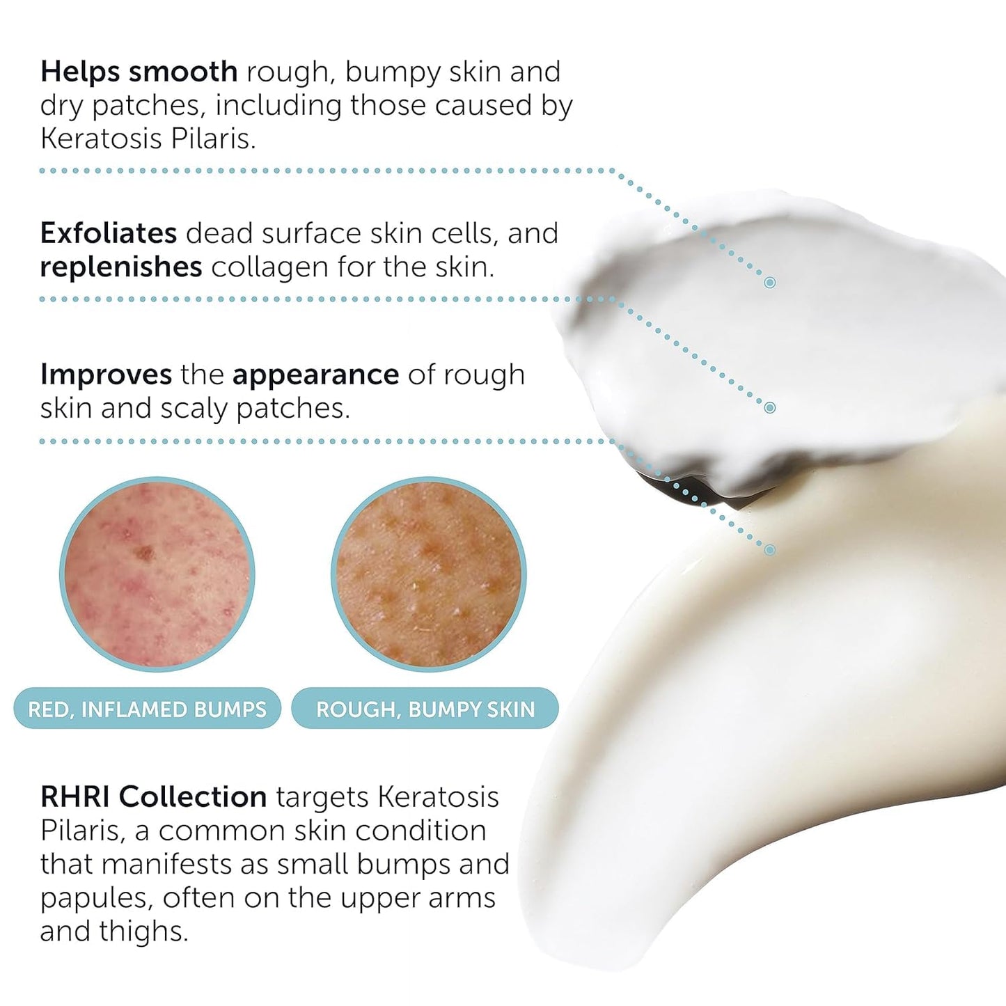 KP Bump Eraser Body Set โ Keratosis Pilaris Lotion & Exfoliating Scrub for Strawberry Legs, Bumps, Redness & Dry Flaky Skin