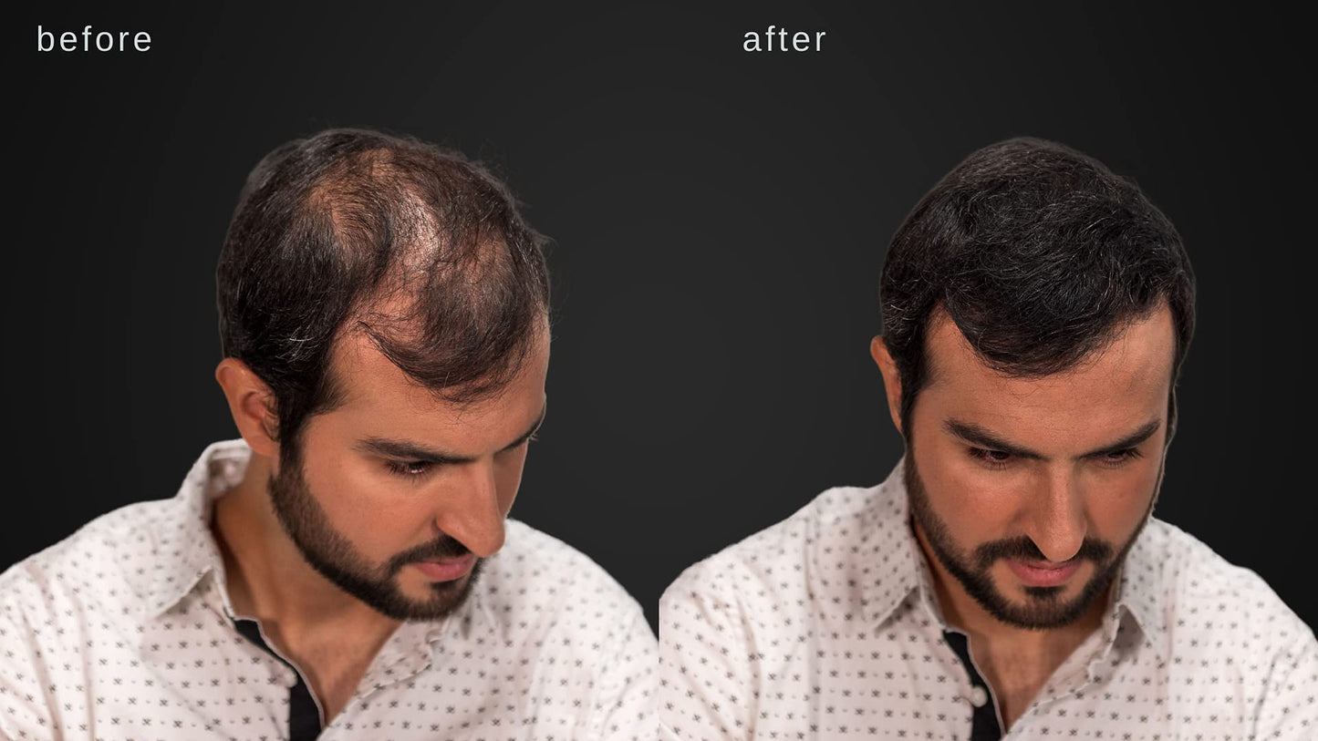 LUXE Hair Building Fibers for Thinning Hair – Dark Brown – Thickening Fibers, Hypoallergenic, Dermatologist Tested, 2+ Month Supply