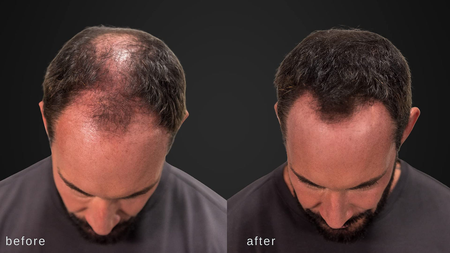 LUXE Hair Building Fibers for Thinning Hair – Dark Brown – Thickening Fibers, Hypoallergenic, Dermatologist Tested, 2+ Month Supply