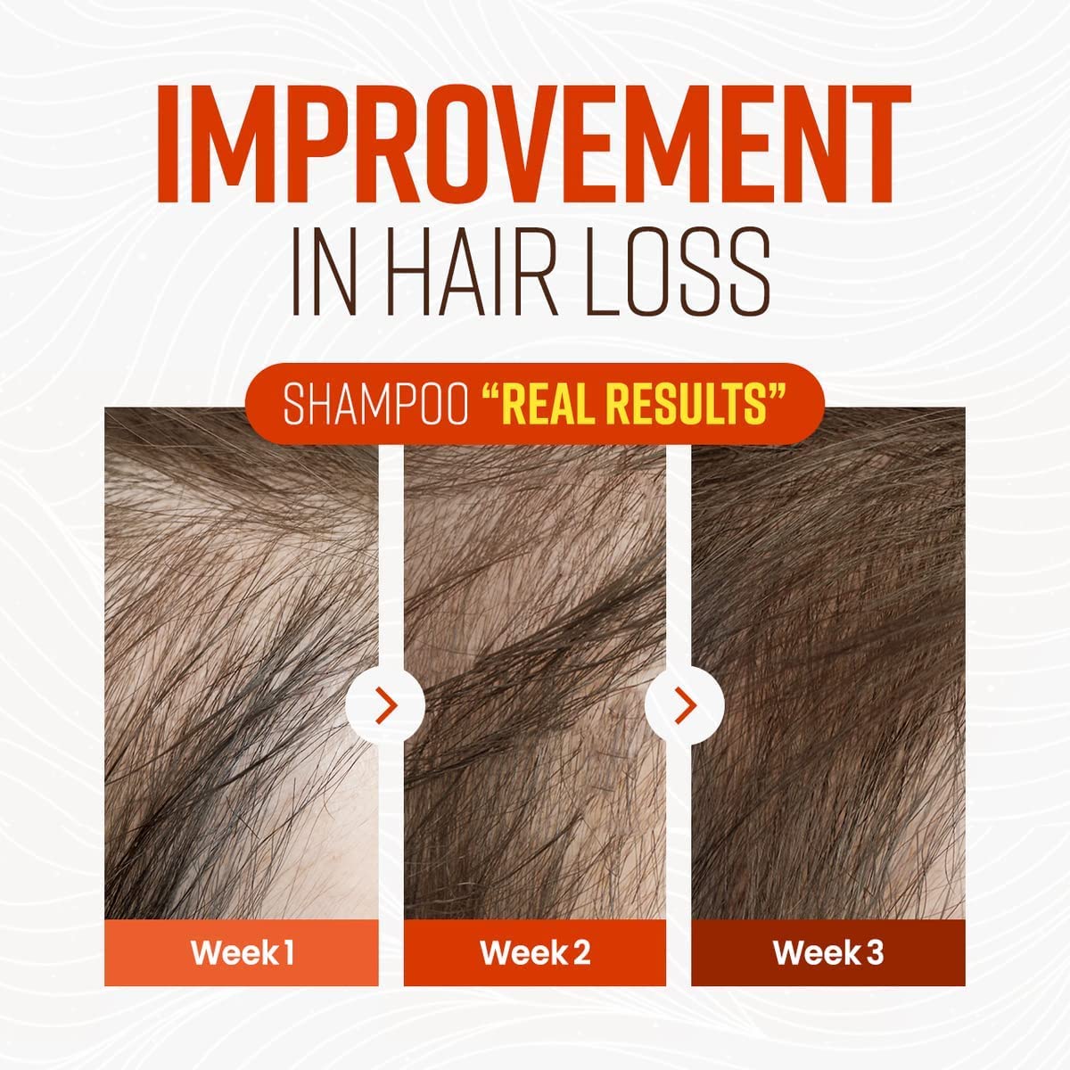 CRAZY SKIN German Beer Yeast Biotin Shampoo 300ml โ Anti-Hair Loss, Thickening, Hard Water Defense, Gentle Exfoliating, Sulfate-Free Formula