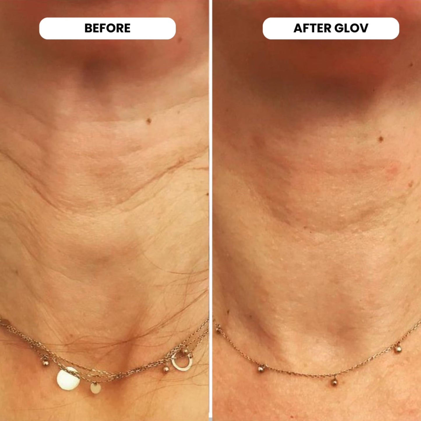 Glov Beauty Micro Infusion System – 0.25mm 24k Gold Facial & Lip Stamp with Hyaluronic Acid, Collagen & Licorice Root Serum Kit