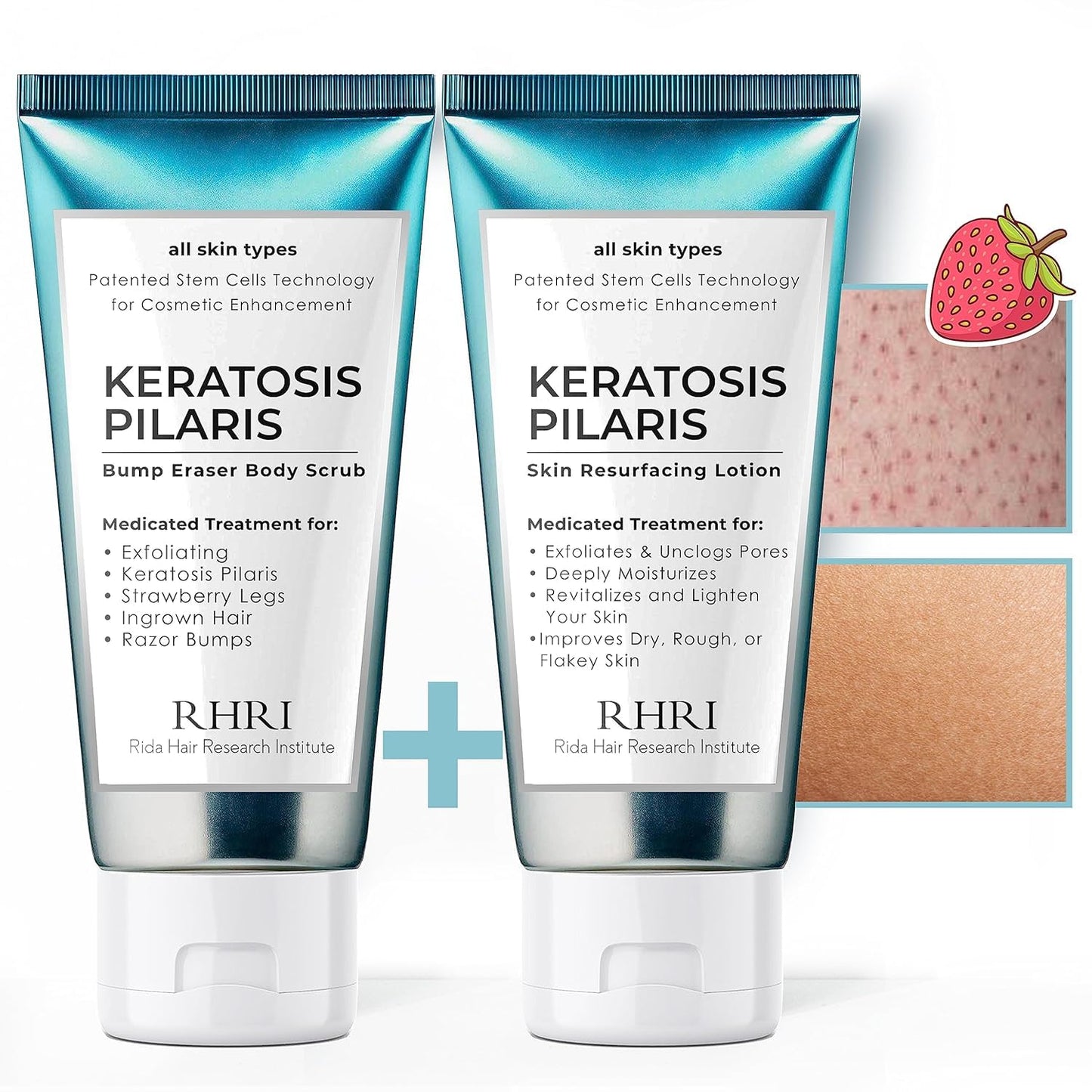 KP Bump Eraser Body Set โ Keratosis Pilaris Lotion & Exfoliating Scrub for Strawberry Legs, Bumps, Redness & Dry Flaky Skin