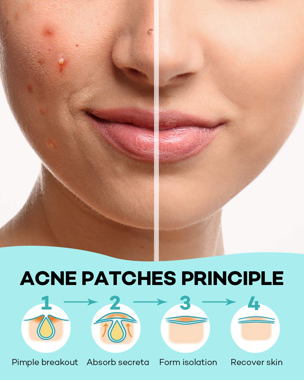 Pimple Patch Acne Cover, 4 Sizes 140 Hydrocolloid Invisible Patches with Tea Tree & Calendula Oil for Face Zits & Acne Spots
