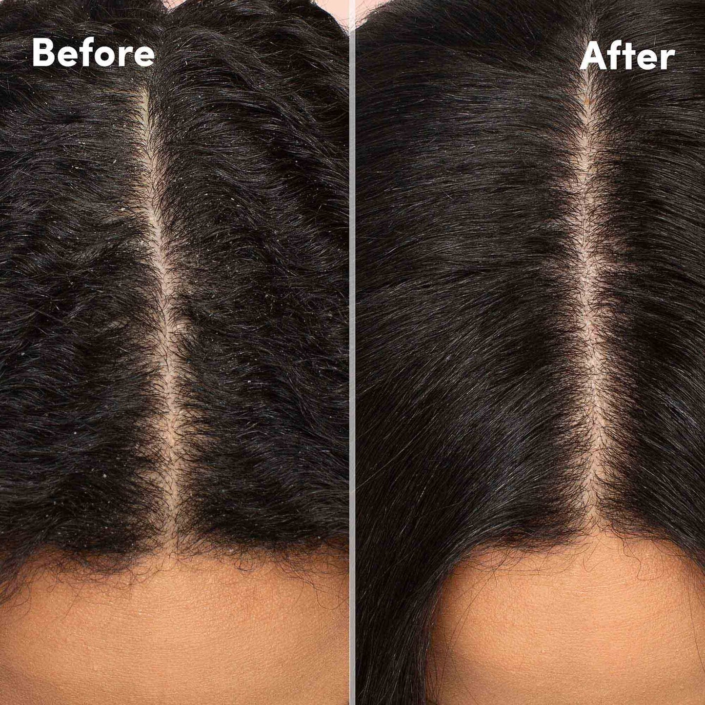 Mizani Scalp Care Calming Scalp Lotion - Dandruff Treatment, Nourishes & Soothes Scalps, For Curly Hair