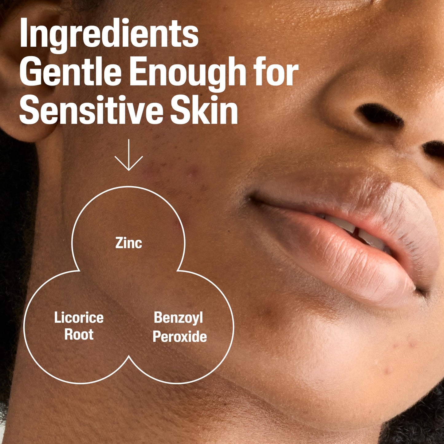 Cetaphil Gentle Clear Acne Cleanser with 2.6% Benzoyl Peroxide – Creamy, Soothing Face Wash for Sensitive & All Skin Types, 4.2 oz