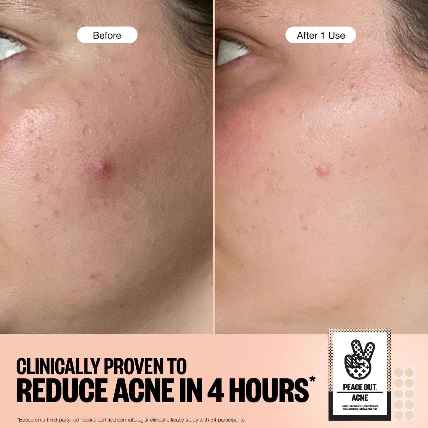 PEACE OUT Acne Healing Dots – Fast-Acting Pimple Patches with Salicylic Acid, Retinol & Aloe Vera, Clears Blemishes Overnight, 40ct