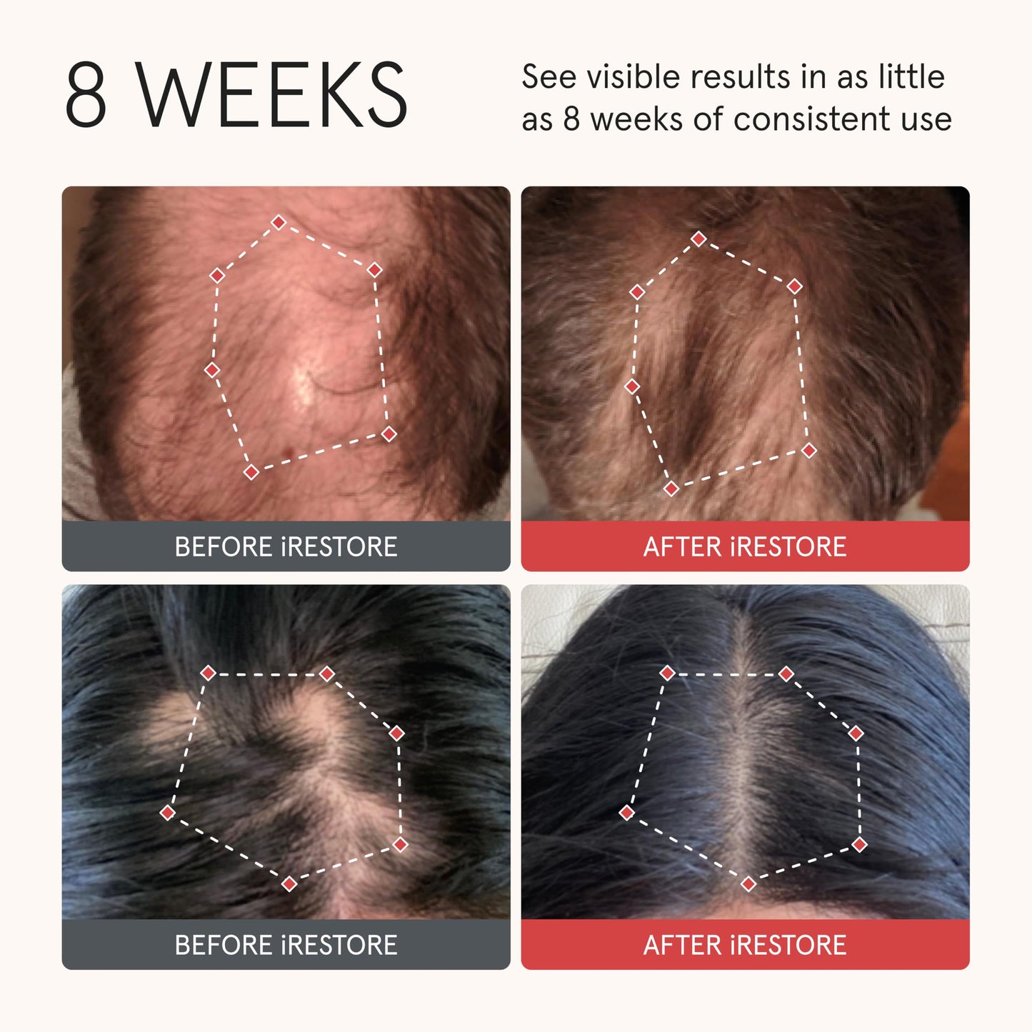 iRestore Anti Hair Loss and Thinning Shampoo - Biotin Formula for Hair Growth, Thickening and Volumizing for Men & Women