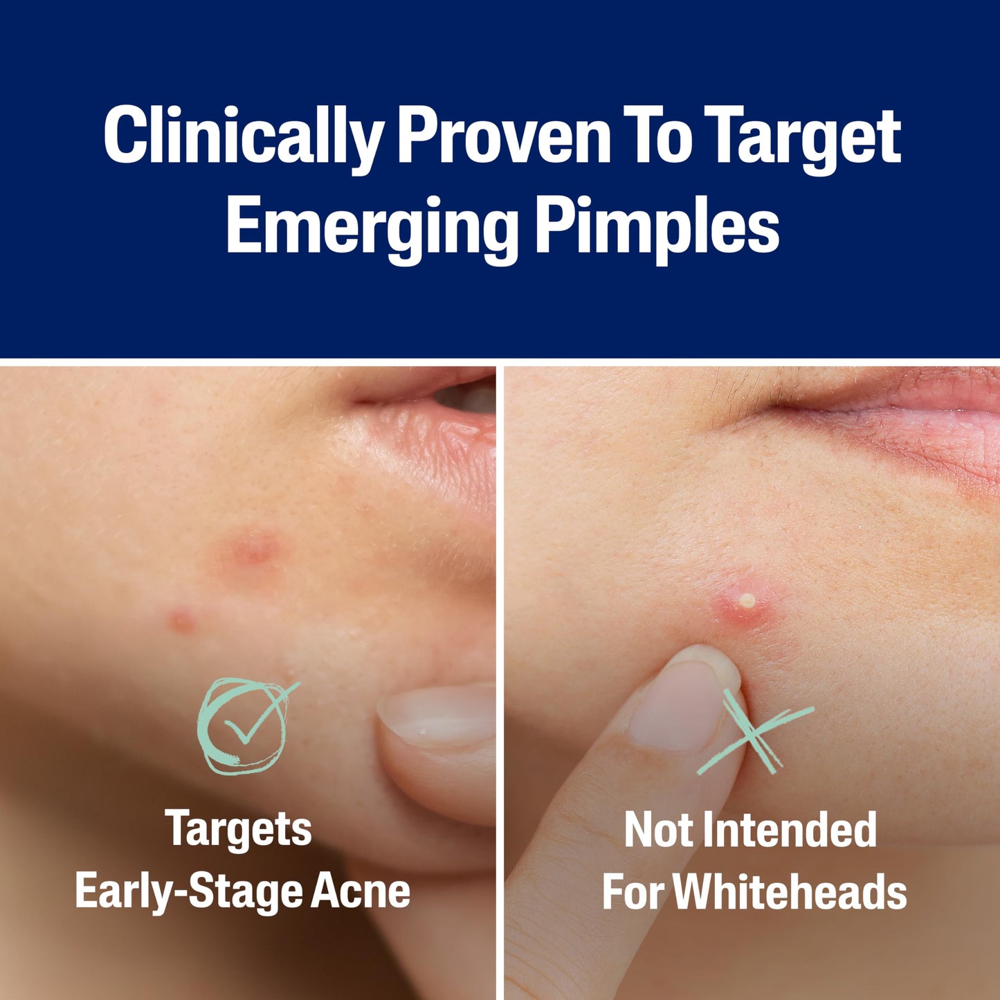 Cetaphil Acne Patches for Sensitive Skin – Salicylic Acid, CICA & Heartleaf Extract, Reduces Pimples in 6 Hours, 24 Count