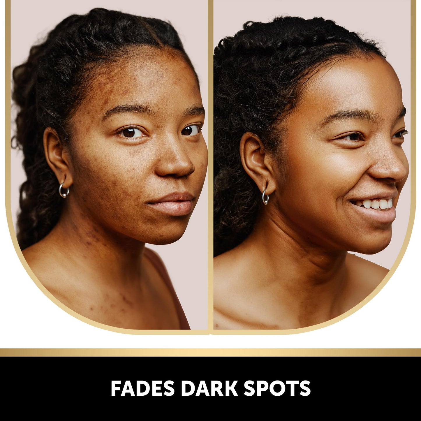 VALITIC Kojic Acid Soap with Vitamin C, Retinol & Turmeric for Dark Spots – Japanese Complex with Collagen, Hyaluronic Acid & Vitamin E, 2 Pack