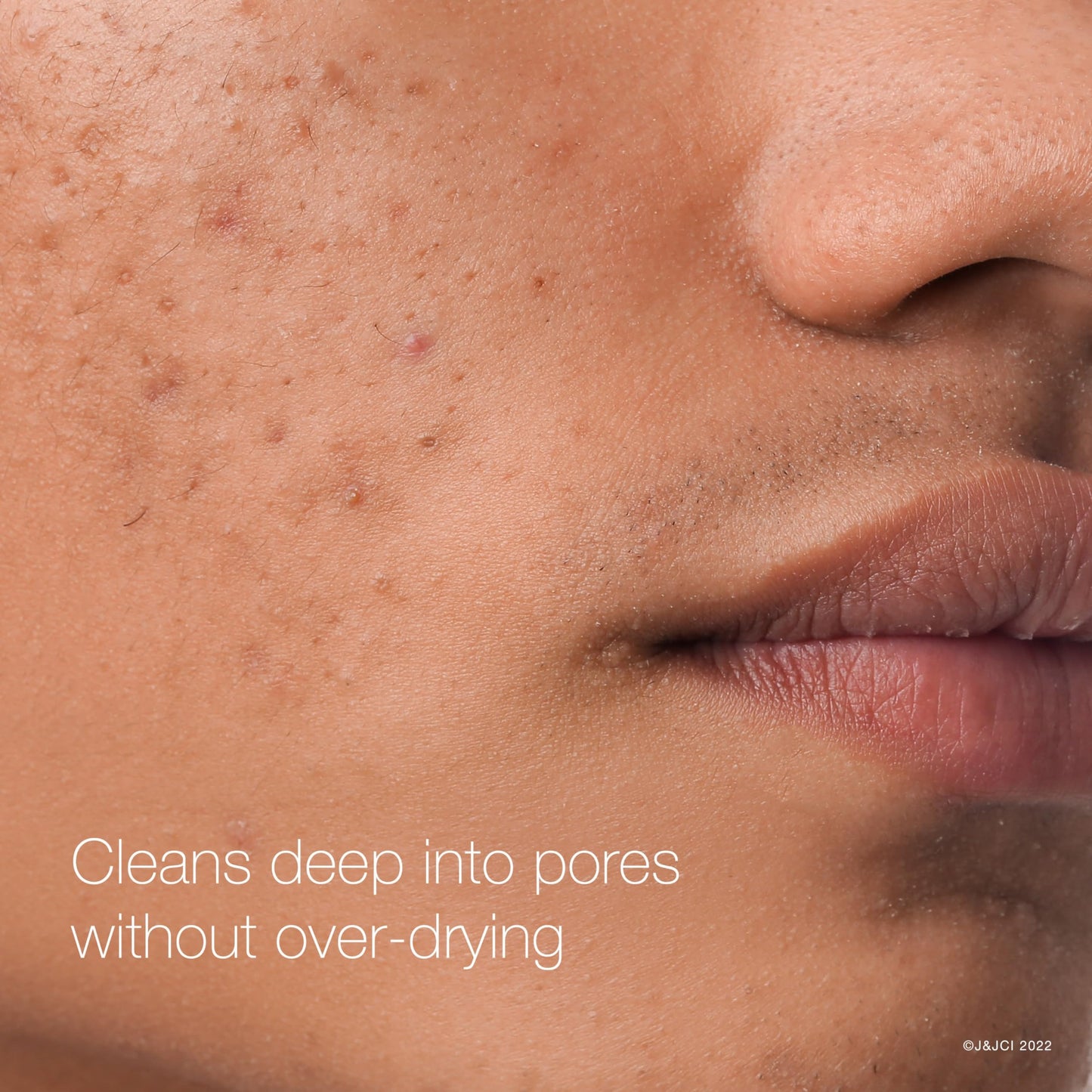 Neutrogena Rapid Clear Acne Face Pads with 2% Salicylic Acid – Maximum Strength, Oil-Free Cleansing Pads for Acne-Prone Skin, 3-Pack