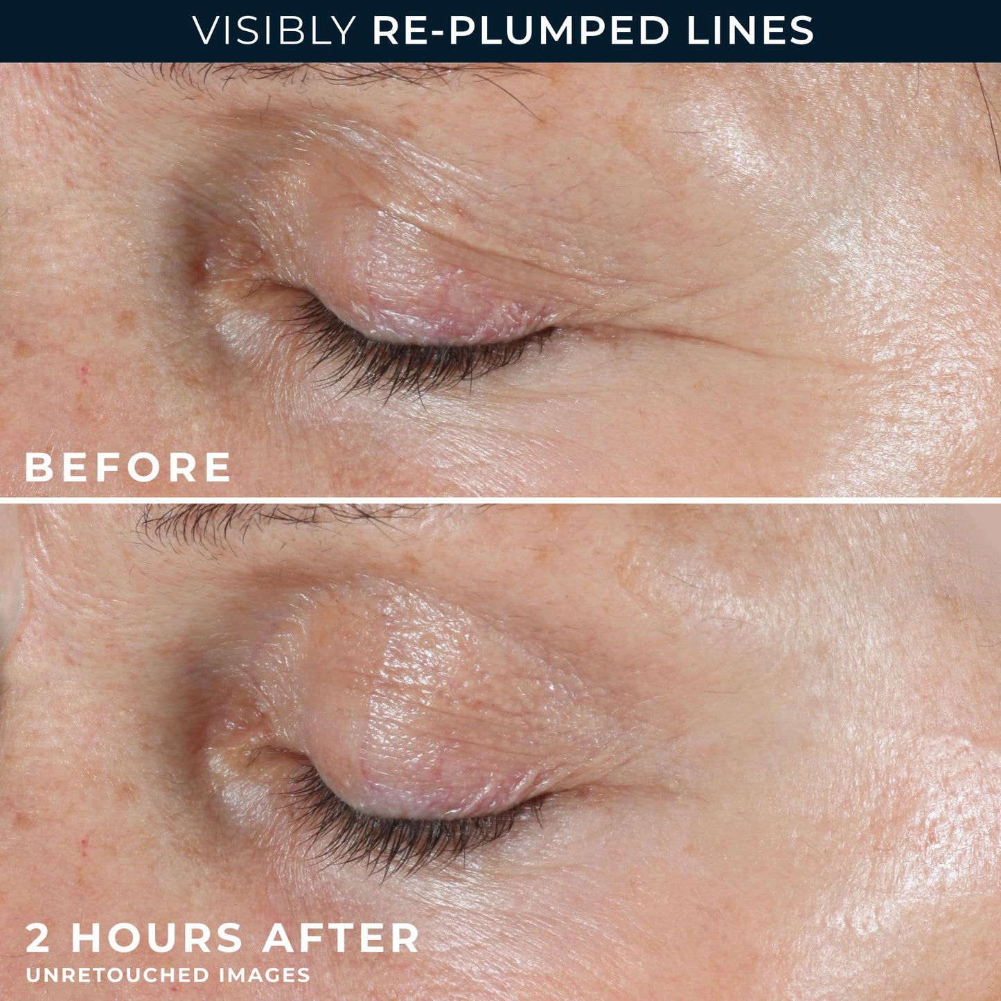 RoC Retinol Correxion Deep Wrinkle Patches with Hyaluronic Acid & Peptides for Forehead, Crow’s Feet & Laugh Lines, 6 Patches