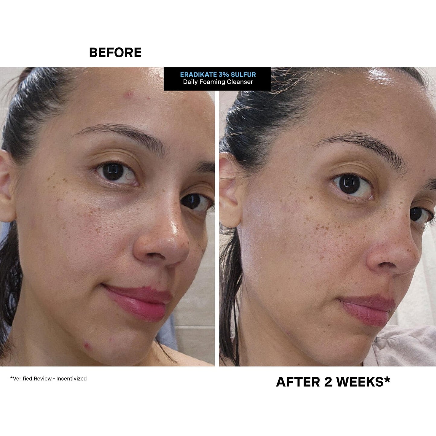 Kate Somerville EradiKate 3% Sulfur Foaming Cleanser – Daily Medicated Acne Face Wash, Balances Skin & Cleans Pores, 4 fl oz