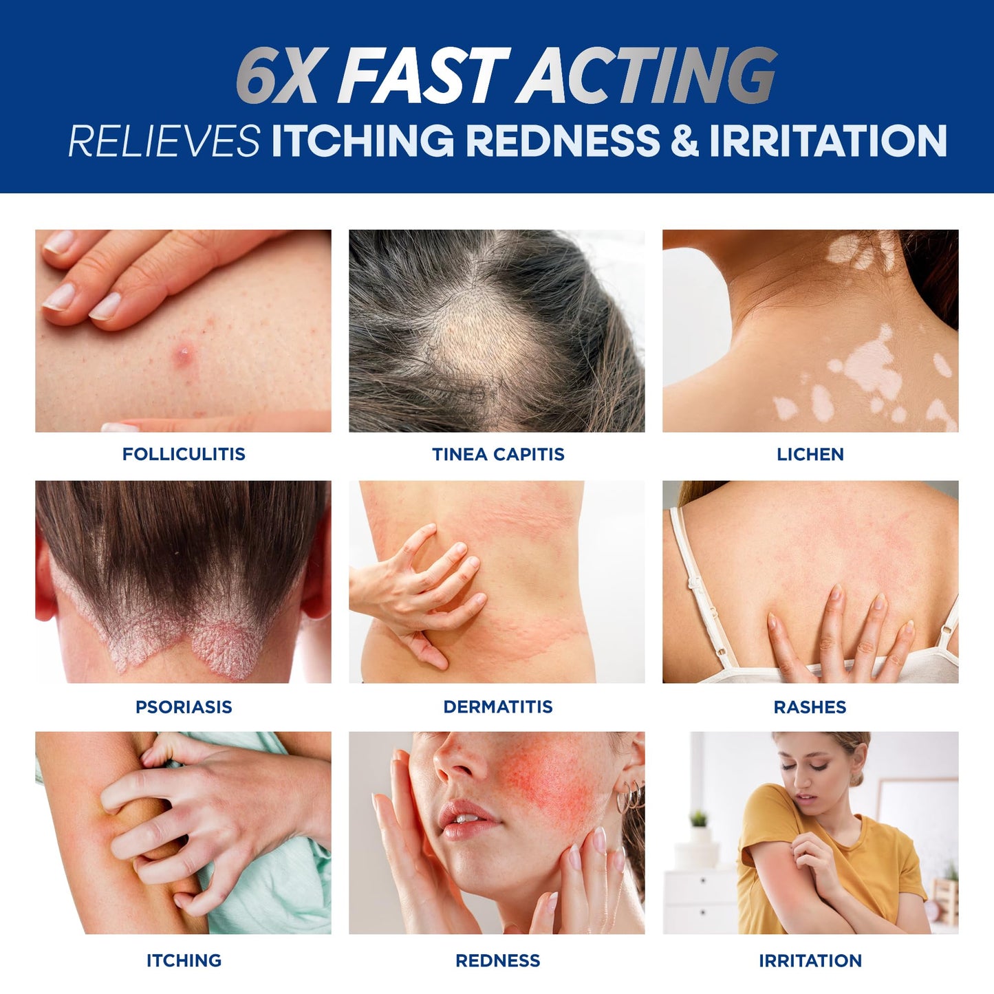 Folliculitis Treatment Cream: Effective Treatment for Folliculitis Scalp Face and Body 100g