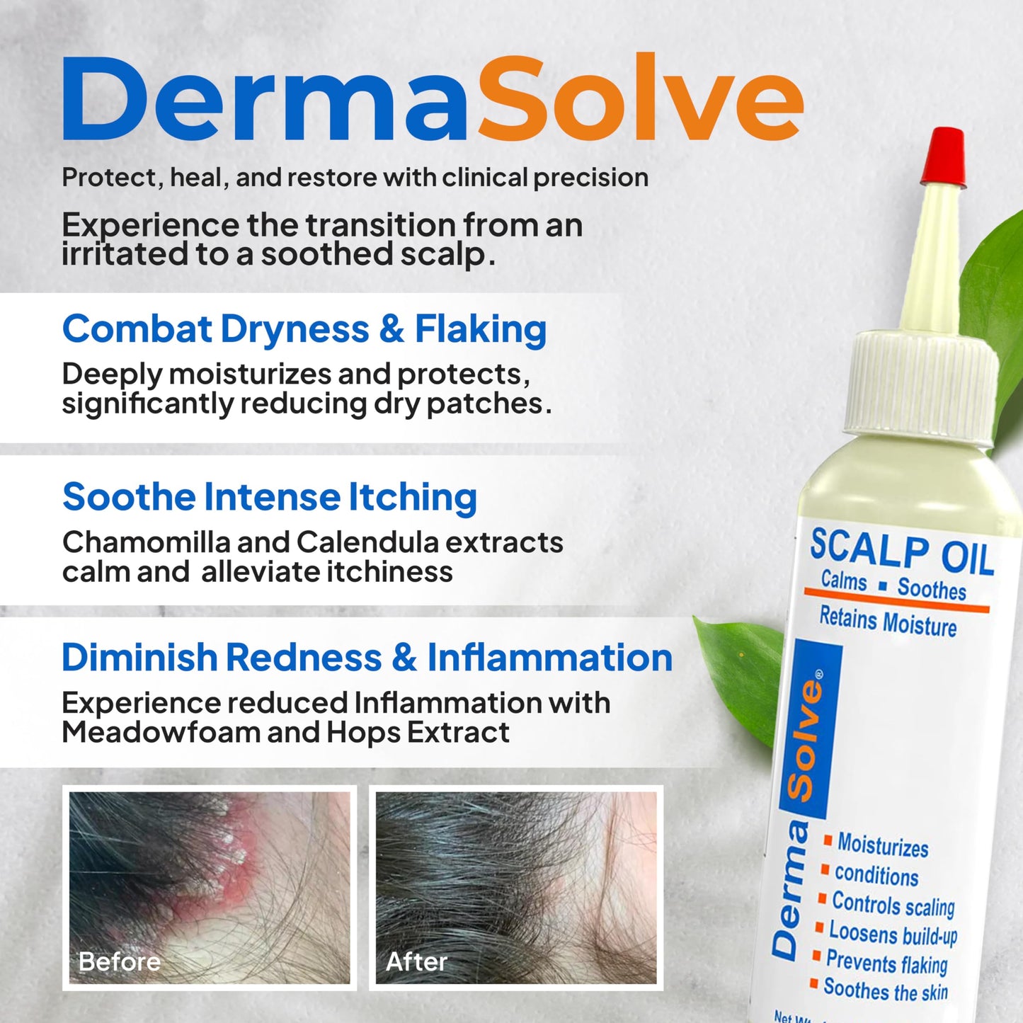 Dermasolve Scalp Oil 4 oz – Psoriasis, Seborrheic Dermatitis & Dandruff Relief – Dermatologist Approved, Itch-Free, Flake Control Formula