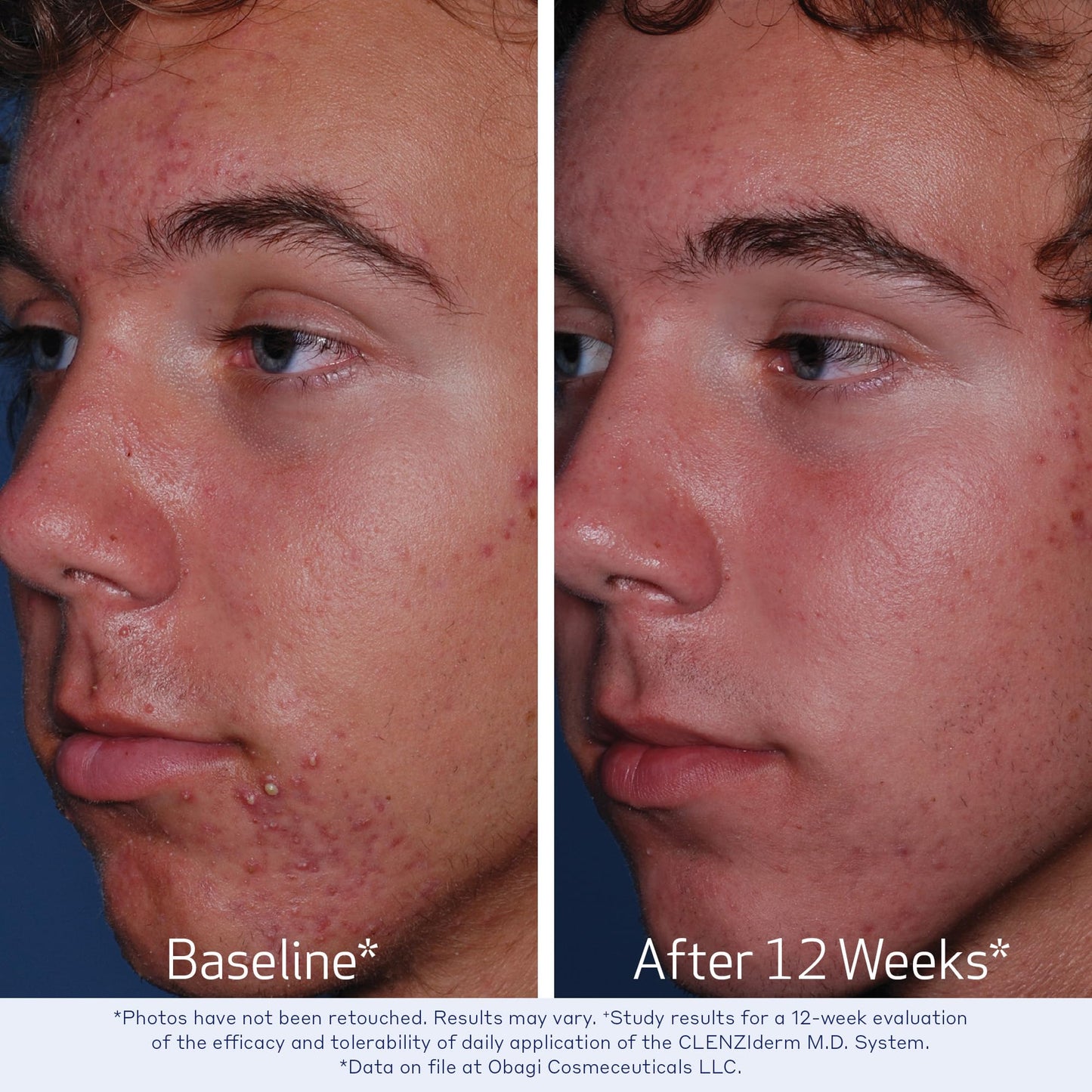 Obagi Medical CLENZIderm M.D. Daily Care Foaming Acne Cleanser - Acne Treatment with 2% Salicylic Acid (BHA) - 4 oz