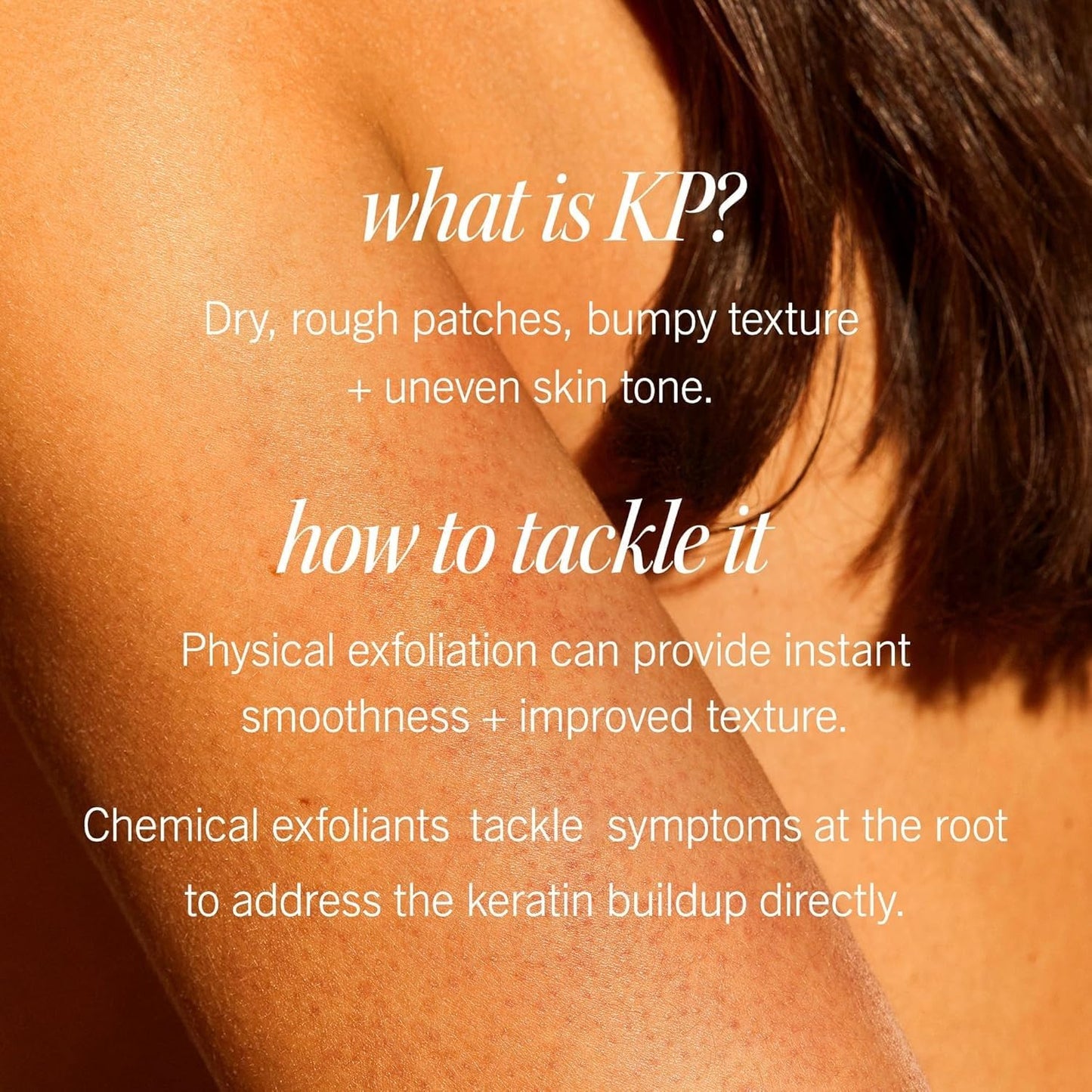 First Aid Beauty KP Bump Eraser Body Scrub 10% AHA – Exfoliates Keratosis Pilaris, Smooths Chicken Skin, Strawberry Scent, 8 oz