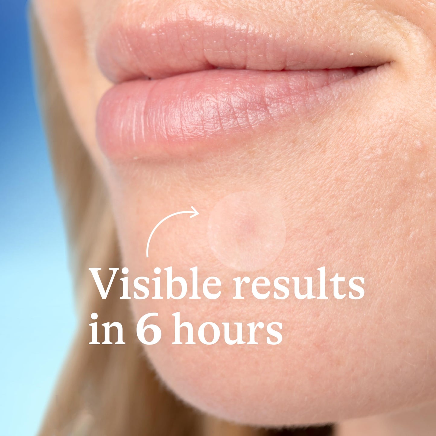 Differin Acne Patches with Salicylic Acid & Centella – Fast Triple Action Pimple Patch for Day & Night, Dermatologist Tested, 36 Count