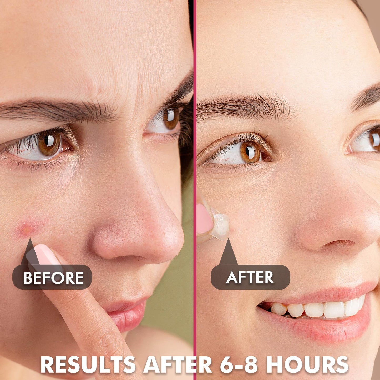 Albatross Health Invisible Pimple Patches – Plain Hydrocolloid Acne Spot Dots, 2 Sizes, 180 Count, HSA/FSA Eligible