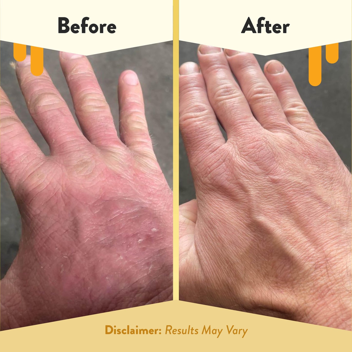 ECZEMA HONEY Gentle Foaming Hand Soap – Unscented, Non-Toxic, Organic Honey Cleanser for Dry Hands, Bathroom & Kitchen, 8.4oz