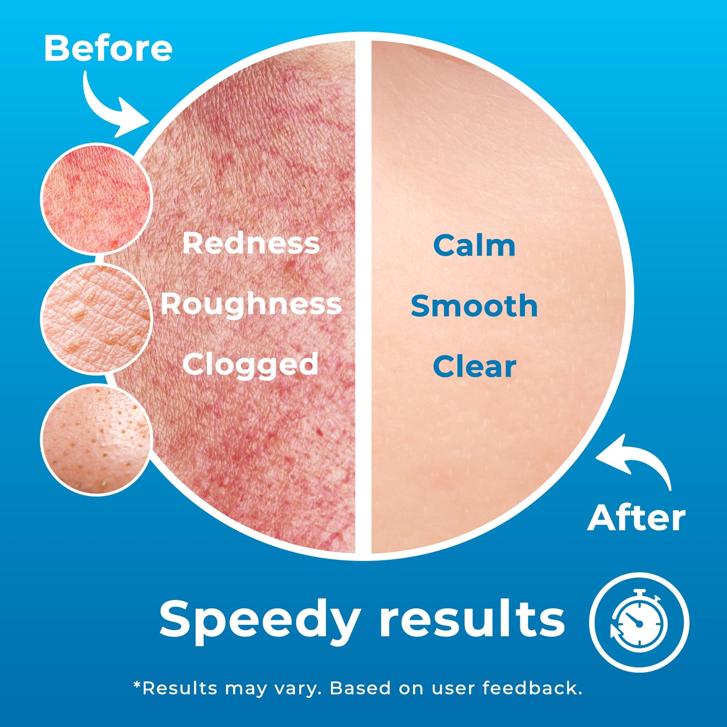 PatchRx Hypochlorous Acid Spray 8oz - HOCL Facial Cleanser for Acne, Pimples, Eczema & Redness - Kills Bacteria, Soothes Skin & Aids Recovery