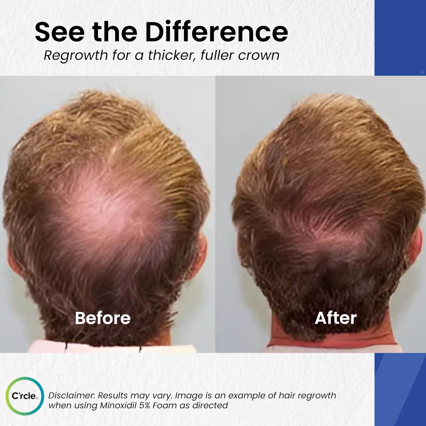 Minoxidil 5% Foam for Men – Unscented, Extra Strength Hair Regrowth Treatment – 3 Month Supply for Thinning & Vertex Hair Loss