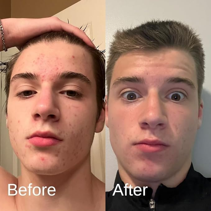 Shield Acne Wash Bundle for Men and Boys – Deep Clean Gel Formula Face Wash and Unscented Back & Chest Cleanser, Clears Acne & Breakouts, 13.6 oz