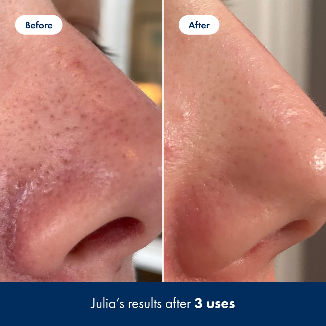 Hero Cosmetics Pore Release Blackhead Clearing Solution, Exfoliating 2% Salicylic Acid Toner Featuring AHA and PHA, Blackhead Remover Toner, 100 ml