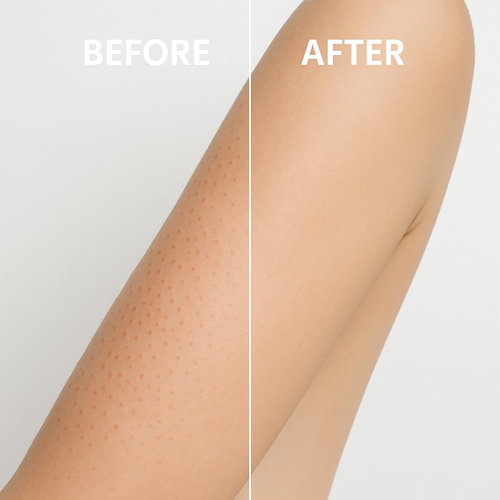 Microdermabrasion KP & Acne Scrub – Deep Cleansing Face & Body Exfoliant for Bumps, Redness, Rough & Dry Skin, Back & Butt Wash