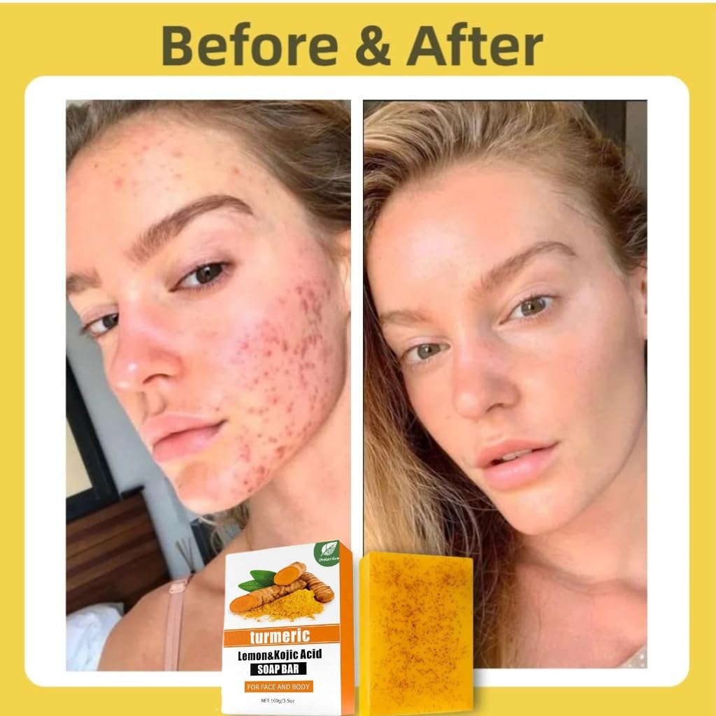 Uselective Kojic Acid & Turmeric Soap for Dark Spot Removal – Skin Lightening with Vitamin C, Retinol, Shea & Lemon Oil, SLS-Free