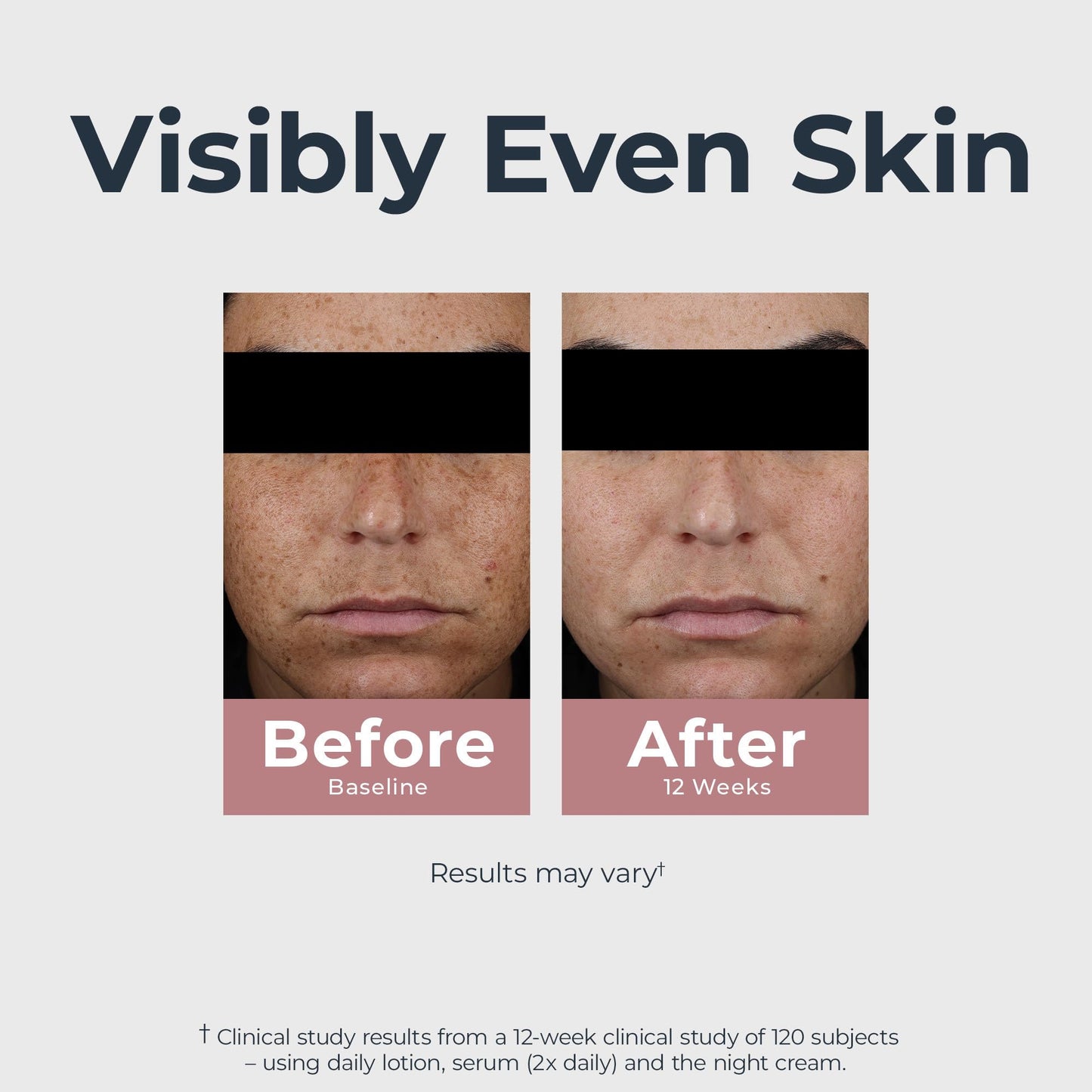 Eucerin Radiant Tone Dual Serum – Dark Spot Corrector with Thiamidol & Hyaluronic Acid, Reduces Persistent Dark Spots, 1 fl. oz.