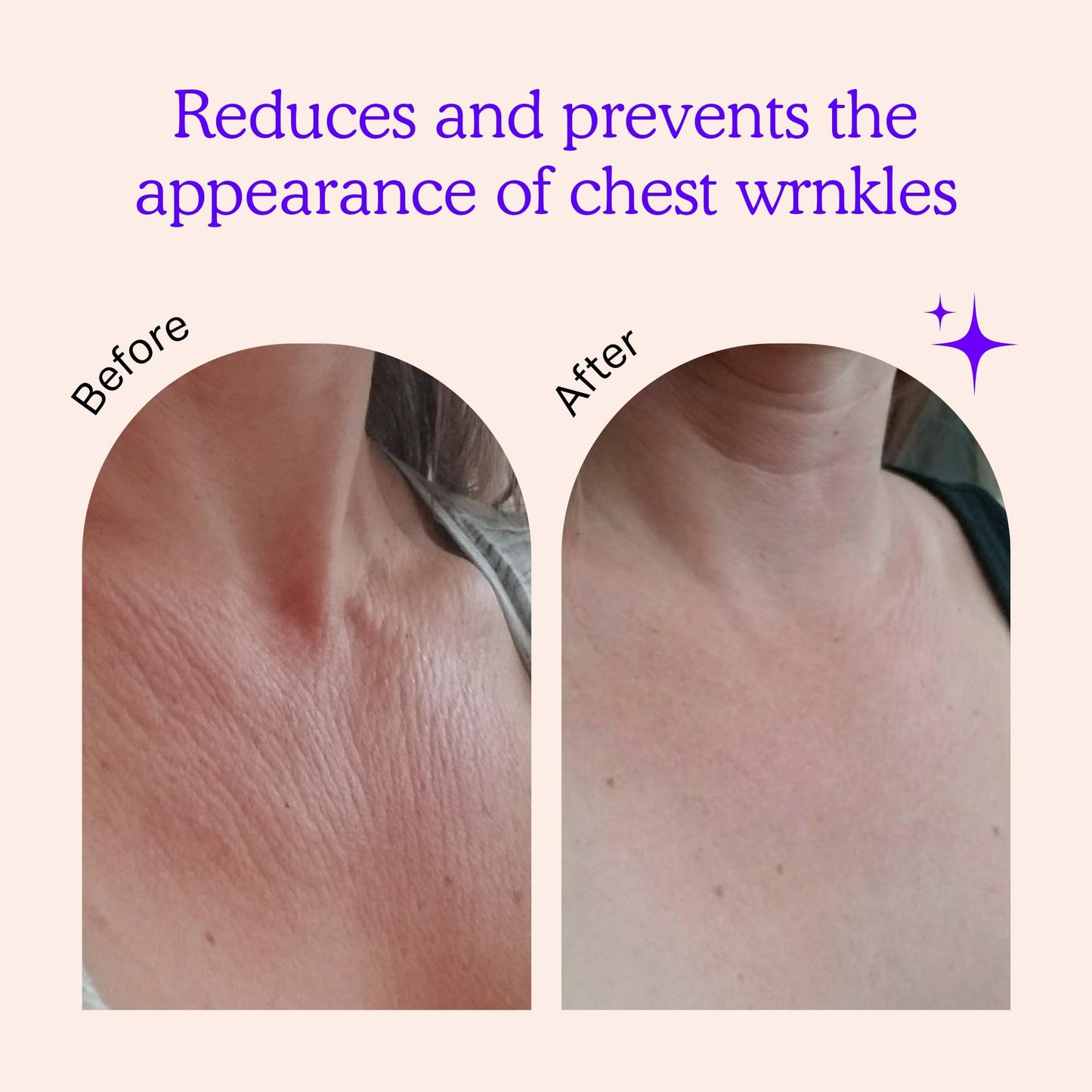 BLUMBODY Chest Wrinkle Pads – Reusable Silicone Anti-Wrinkle Patches for Neck & Décolleté, Skin Firming & Smoothing, 1-Month Supply