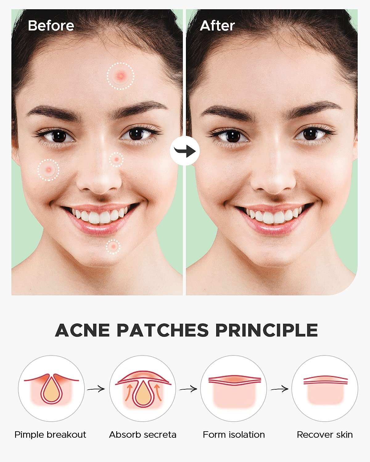 ZATKTK Acne Pimple Patch - 180 Hydrocolloid Spot Patches, 4 Sizes, Tea Tree & Calendula Oil, Invisible Acne Treatment for Face, FSA Eligible