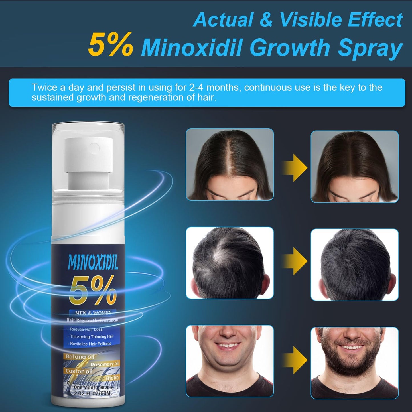 5% Minoxidil Hair Growth Serum for Men & Women – Extra Strength Hair Loss Solution with Biotin, Batana & Rosemary for Thicker Hair & Beard, 2.02 Fl Oz