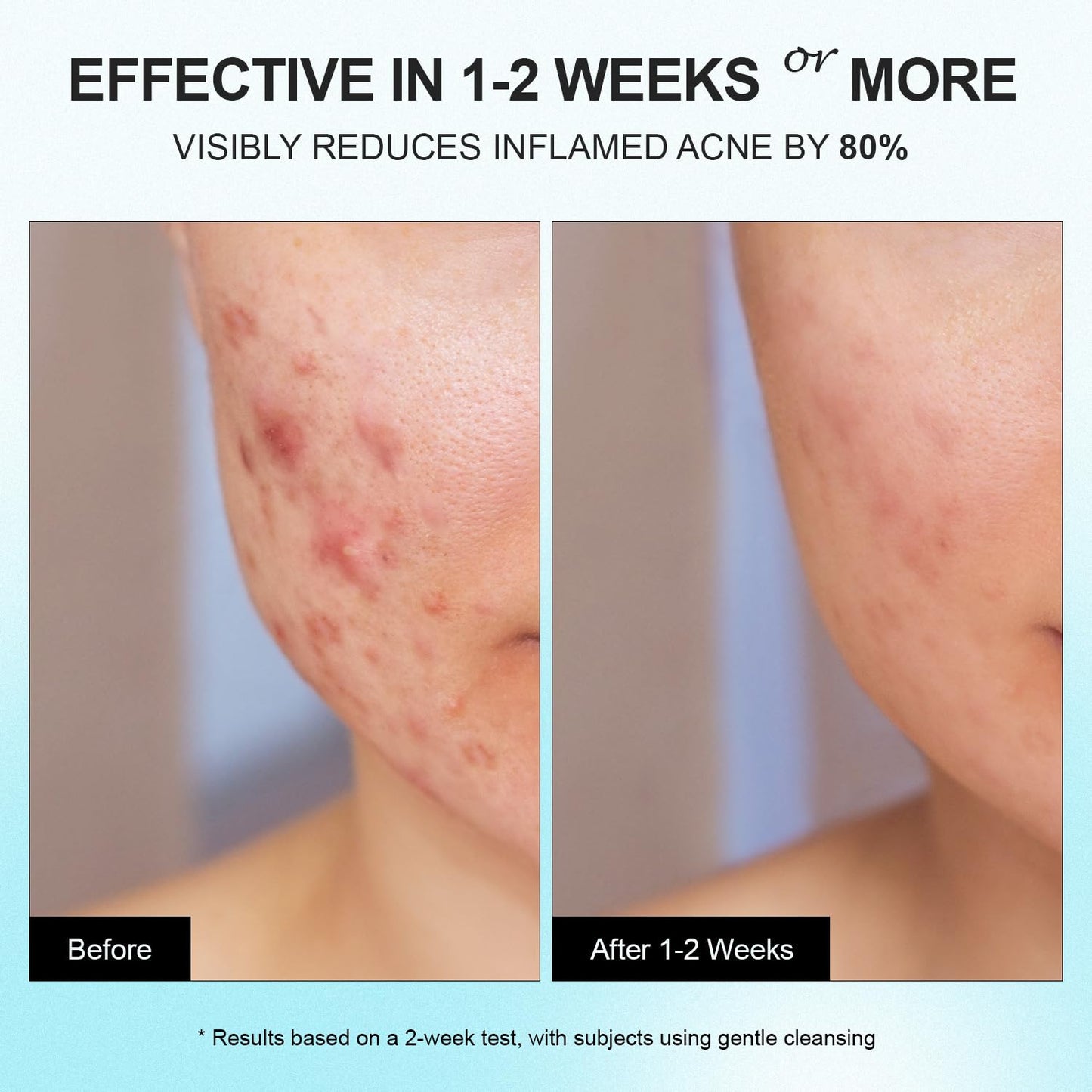 Acne & Pimple Spot Treatment Cream with 10% Azelaic Acid – Blemish, Blackhead & Cystic Acne Remover for Face, Back & Body, 1.8 oz