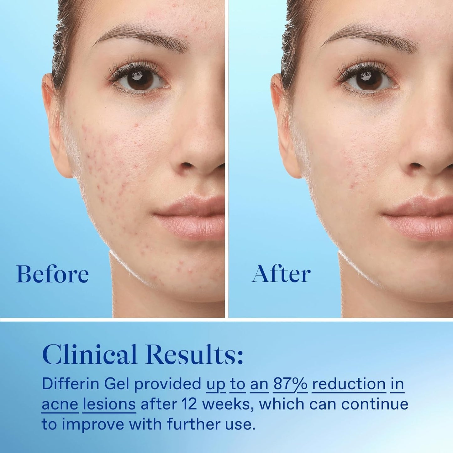 Differin 0.1% Adapalene Acne Treatment Gel, 60-Day Supply, Gentle Retinoid for Sensitive, Acne-Prone Skin, 15g Tube, 2-Pack