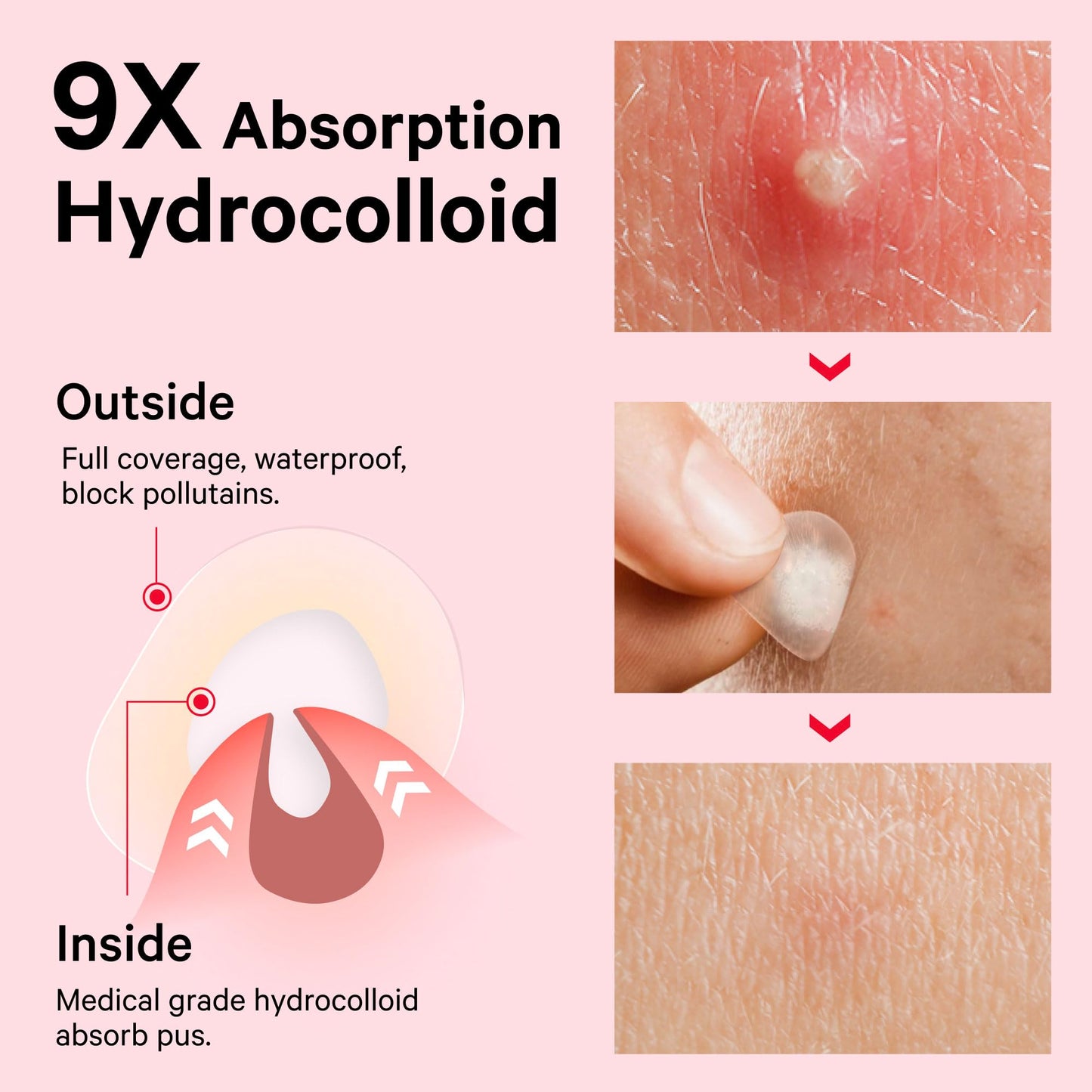 Sosky Invisible Hydrocolloid Acne Patches with Salicylic Acid – Pimple & Blemish Cover Stickers for Face, 48 Count, HSA Eligible