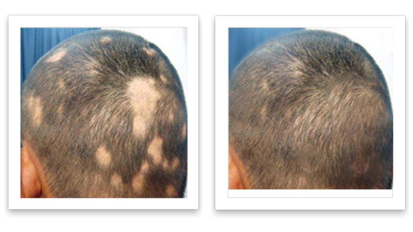 Caboki 10X Volumizing Hair Powder for Thinning Hair: Root Touch Up for Men and Women, Fill in Hairline & Edges, Cover Bald Spots. TALC-Free, Dark Gray